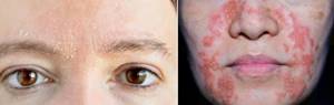 Себорейный дерматит на лице - лечение