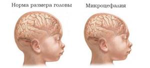 Микроцефалия у детей: симптомы, причины, диагностика у плода и новорожденных