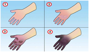 Что делать при обморожении пальцев, рук, ног, щек, уха, носа в домашних условиях