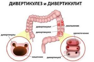 Дивертикулез кишечника: симптомы, лечение