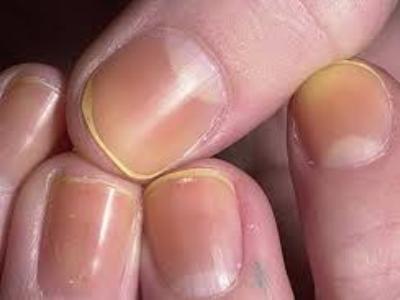Почему желтеют ногти на руках и ногах: лечение, причины