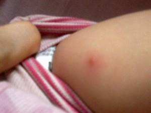 Ребенок после прививки: температура, уплотнение, боль, покраснение, осложнения