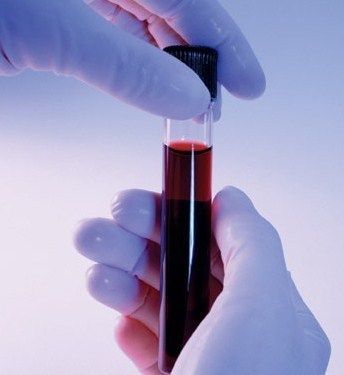 Биохимический анализ крови: норма, расшифровка, причины отклонения результатов