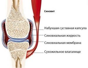 Синовит коленного сустава: симптомы, лечение, диагностика, классификация