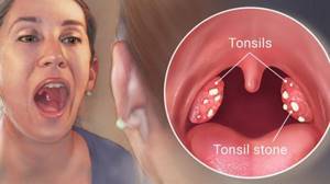 Хронический тонзиллит - симптомы, лечение, причины
