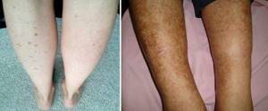 Темные пятна на коже: причины на руках, ногах, животе, после бритья, загара