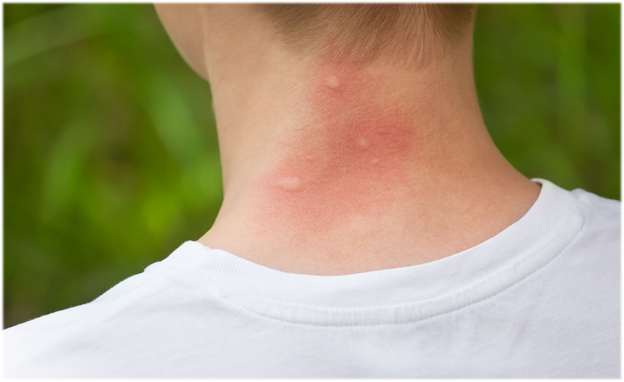 Чем можно заразиться от укуса мух и комаров