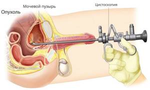 Цистоскопия мочевого пузыря: как делают у женщин, мужчин, показания, подготовка, результаты