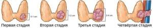 Рак щитовидной железы - симптомы, лечение, стадии