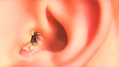 Грибок в ушах: лечение, симптомы, причины