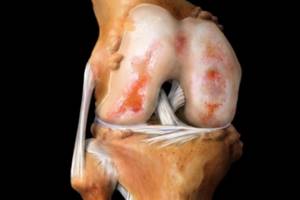 Артроз коленного сустава: лечение