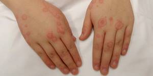 Холодовая аллергия - такое бывает? Симптомы и лечение неадекватной реакции организма на холод