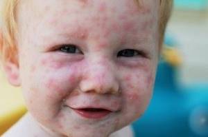 Краснуха у детей: симптомы, диагностика, лечение, вакцинация