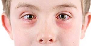 Аллергический конъюнктивит: лечение, симптомы