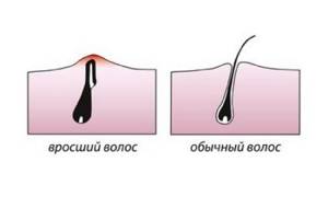 Вросший волос в области бикини, на ногах: как избавиться, удалить, профилактика, причины врастания волос