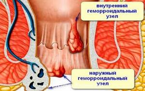 Геморрой у женщин: симптомы, признаки, причины, лечение