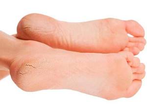 Лечение трещин на пятках, крема, мази, ванночки, народные средства для увлажнения,заживления растрескавшейся кожи ног