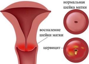 cимптомы и лечение острого и хронического цервицита шейки матки