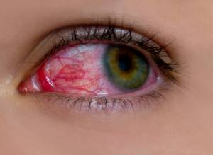 Ожоги глаз сваркой, химический ожог: что делать, лечение, первая помощь