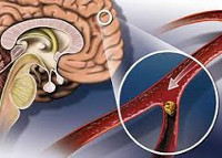 Атеросклероз сосудов головного мозга - лечение, симптомы