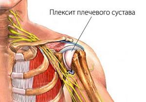 Боль в плечевом суставе: причины, лечение боли в плече правой или левой руки