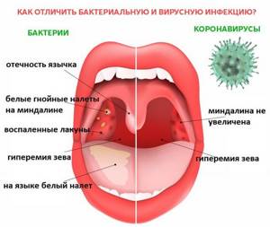 Боль в горле при коронавирусе: сильная, без температуры, чем лечить