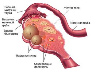 Лапароскопия кисты яичника
