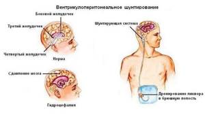 Гидроцефалия головного мозга у взрослых- симптомы, лечение