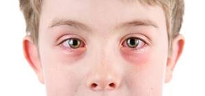 Аллергия вокруг глаз - симптомы, лечение, фото