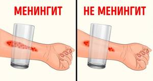 Причины возникновения вспышки серозного менингита в Новосибирской области