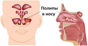 Полипы в носу: лечение гомеопатией, народными средствами, методы терапии без операции