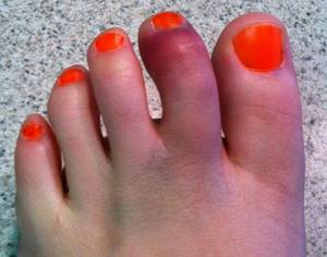 Перелом пальца на ноге: симптомы, признаки, лечение