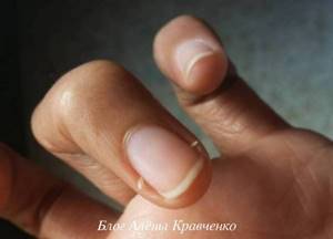 Заусенцы на пальцах рук: причины, как убрать, лечение частых надрывов кожи вокруг ногтя