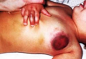Гемофилия: симптомы, признаки, лечение у детей