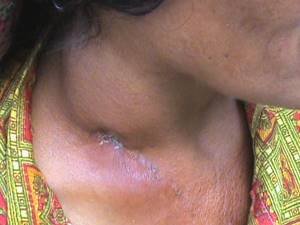 Воспаление лимфоузлов на шее: симптомы и лечение шейного лимфаденита, причины почему болят лимфоузлы на шее