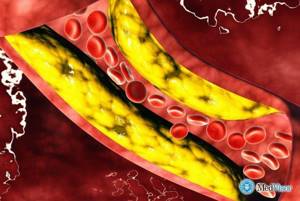 Повышенный холестерин в крови - мифы и реальность