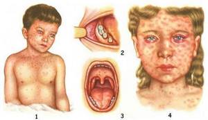 Корь: симптомы у детей, лечение