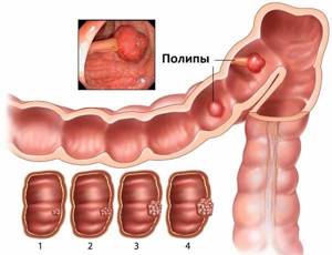Полипы в кишечнике: симптомы, лечение, удаление