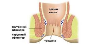 Трещины в заднем проходе: лечение, симптомы