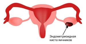 Эндометриоидная киста яичника: операция, лечение,  народные средства