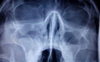 Рентген пазух носа: как делают, описание при гайморите, что показывает