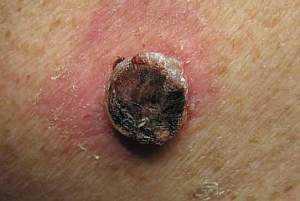 Рак кожи: признаки, симптомы, лечение