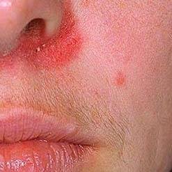 Себорейный дерматит на лице - лечение