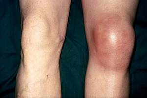 Артрит коленного сустава: лечение, симптомы, причины