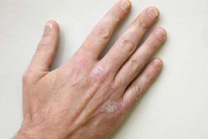 Трещины на пальцах рук: причины возникновения, лечение, крема, маски