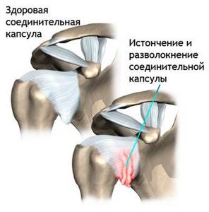 Боль в плечевом суставе: причины, лечение боли в плече правой или левой руки