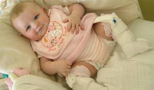 Дисплазия тазобедренного сустава у новорожденного ребенка