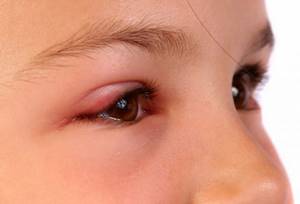 Красные глаза: причины, что делать, лечение у детей и взрослых