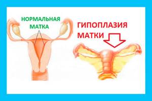 Гипоплазия матки: причины детской матки, возможно ли лечение и беременность