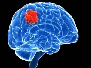 Опухоль головного мозга: симптомы, причины, лечение, виды, диагностика, прогноз